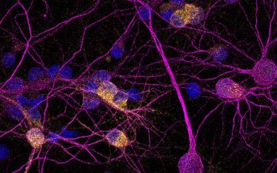 Identifican una proteína clave para la supervivencia de las neuronas en la enfermedad de Huntington