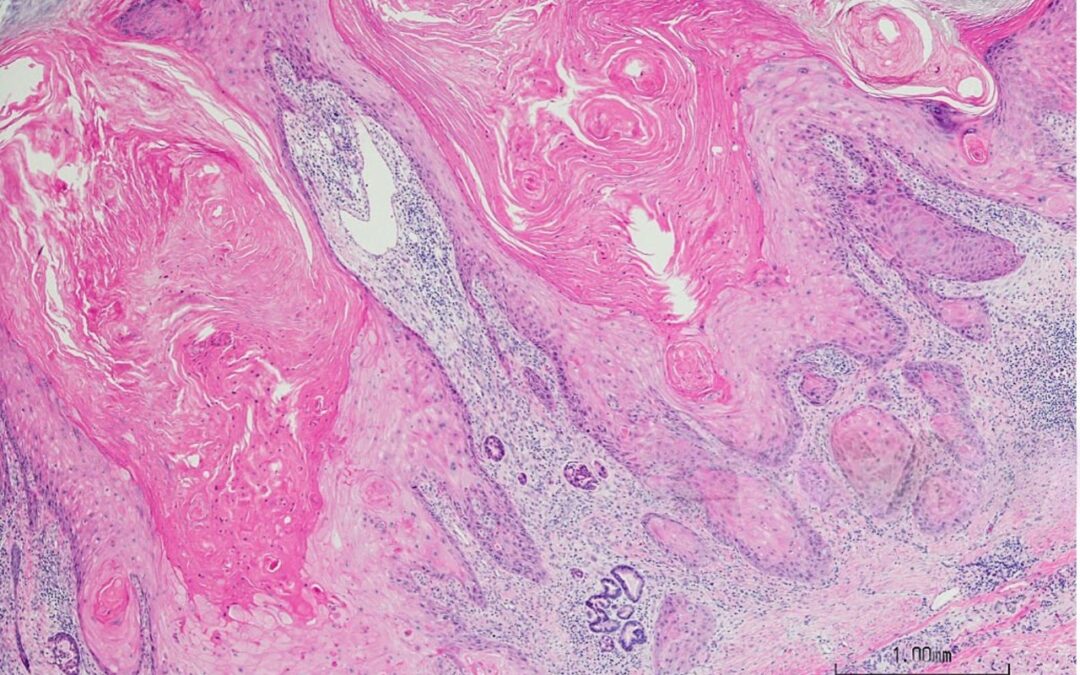 Identifican una estrategia para aumentar la eficacia del tratamiento no invasivo contra un tipo común de cáncer de piel