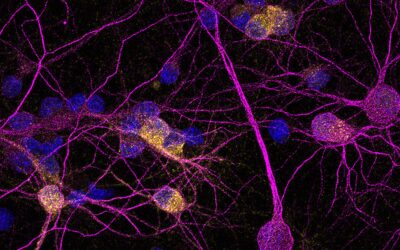 Identifican un factor clave para la supervivencia de las neuronas en la Enfermedad de Huntington