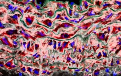 Descubren una nueva causa de los aneurismas en la aorta y una posible vía para prevenirlos sin cirugía