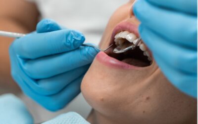 Las bacterias de las encías anticipan el riesgo de padecer periodontitis