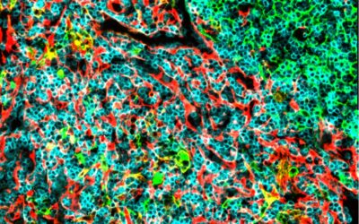 Una nueva esperanza para el tratamiento de la leucemia linfoblástica aguda de células T