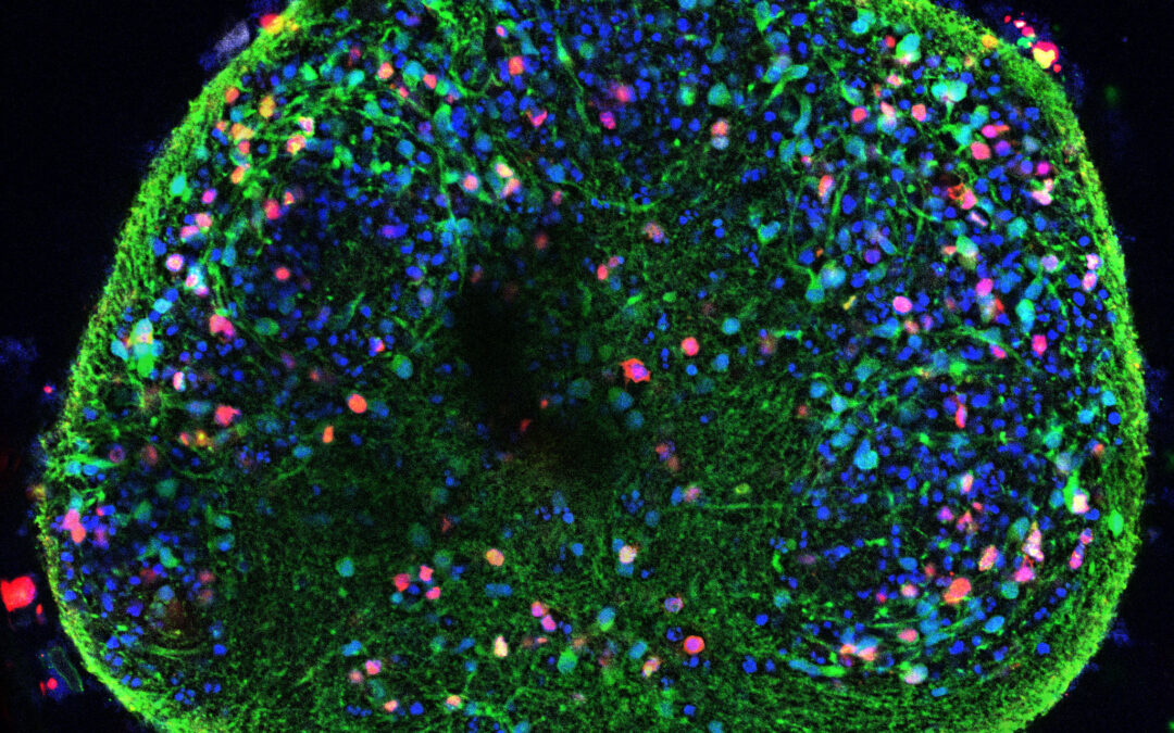 El virus del herpes labial puede activar alteraciones propias de la enfermedad de Alzheimer en neuronas humanas