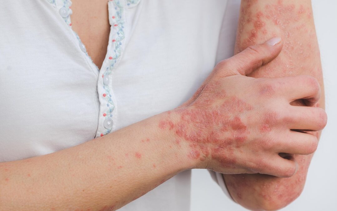 Un fármaco ya aprobado para otro uso reduce la inflamación asociada a la psoriasis en un modelo experimental
