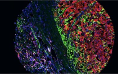 Una nueva estrategia experimental reduce la metástasis del melanoma y mejora la respuesta a la inmunoterapia en ratones