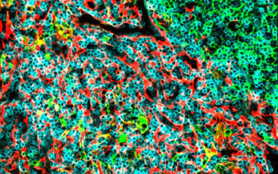 Pequeñas moléculas del organismo podrían ayudar a frenar el crecimiento de un tipo de leucemia muy agresiva