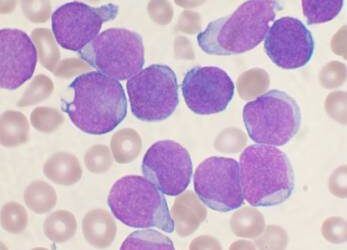 Un nuevo método permite anticipar qué pacientes responderán peor al tratamiento de la leucemia infantil