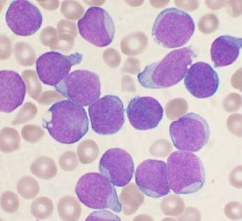 imagen leucemia