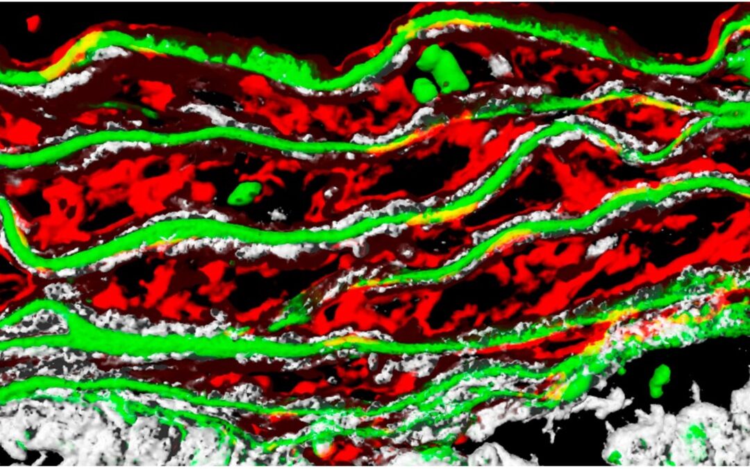 Una investigación del CBM identifica una señal molecular anómala que impulsa la formación de aneurismas hereditarios